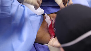 4. Beverly Hills Vagina | Labiaplasty by Dr. Katzen