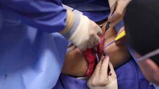 5. Beverly Hills Vagina | Labiaplasty by Dr. Katzen