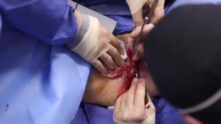 6. Beverly Hills Vagina | Labiaplasty by Dr. Katzen