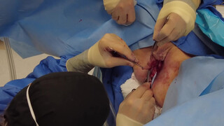 7. Beverly Hills Vagina | Labiaplasty by Dr. Katzen