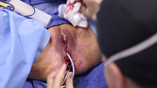 8. Beverly Hills Vagina | Labiaplasty by Dr. Katzen