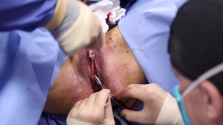 9. Beverly Hills Vagina | Labiaplasty by Dr. Katzen