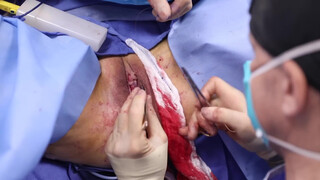 10. Beverly Hills Vagina | Labiaplasty by Dr. Katzen