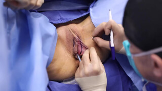2. Beverly Hills Vagina | Labiaplasty by Dr. Katzen