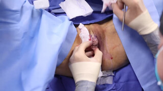 3. Beverly Hills Vagina | Labiaplasty by Dr. Katzen