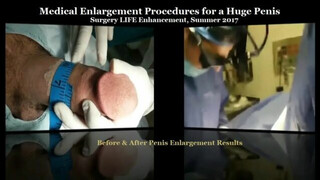 Medical Enlargement Procedures for a Huge Penis