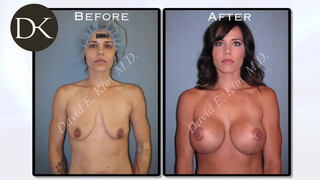 9. Mother of 2 regains her Breasts after a full lift augmentation