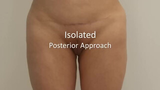 6. Labia Majoraplasty 2013