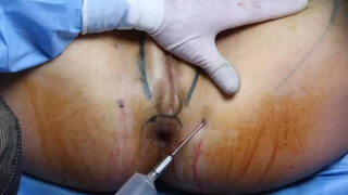 9. Labia Majoraplasty 2013