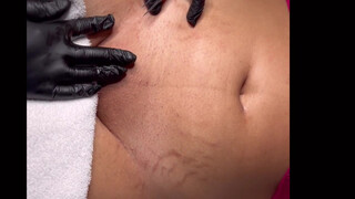 6. Post Bikini Brazilian Wax| Vajacial Demo