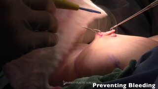 7. Breast Augmentation | Pectus Excavatum Surgery | Dr. Daniel Barrett | Beverly Hills