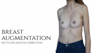 Breast Augmentation | Pectus Excavatum Surgery | Dr. Daniel Barrett | Beverly Hills