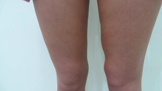 4. Patient 531: Revision inner thighs liposuction in Medan, after botched liposuction in France