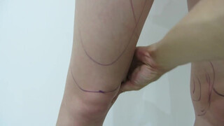 6. Case No. 20, Video 1: Thighs liposuction. Another masterpiece! Pre-op marking.