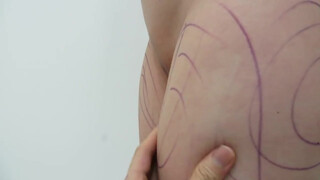 7. Case No. 20, Video 1: Thighs liposuction. Another masterpiece! Pre-op marking.