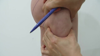 10. Case No. 20, Video 1: Thighs liposuction. Another masterpiece! Pre-op marking.