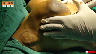 7. Female Scarless Breast Reduction  Dr. Prashant . Dezire Clinic India