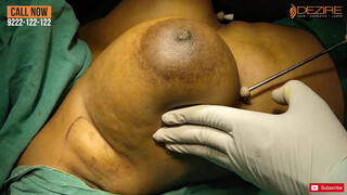8. Female Scarless Breast Reduction  Dr. Prashant . Dezire Clinic India