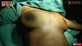 9. Female Scarless Breast Reduction  Dr. Prashant . Dezire Clinic India