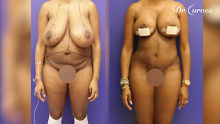 8. Woman Gets Breast Reduction to Improve Quality of Life